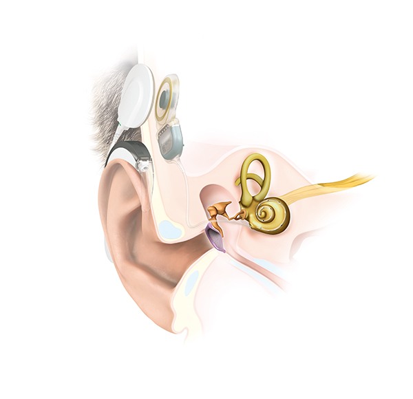 Schemazeichnung eines Cochlea-Implantats Schemazeichnung eines Cochlea-Implantats